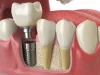 Understanding the Healing Process with Dental Implants