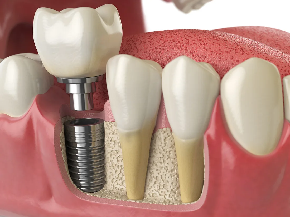 Understanding the Healing Process with Dental Implants