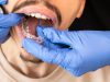 Crafting Perfect Crowns: Innovations in Dental Restoration Techniques